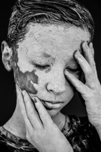 背中のニキビによる色素沈着を男性が治すための効果的な方法は？